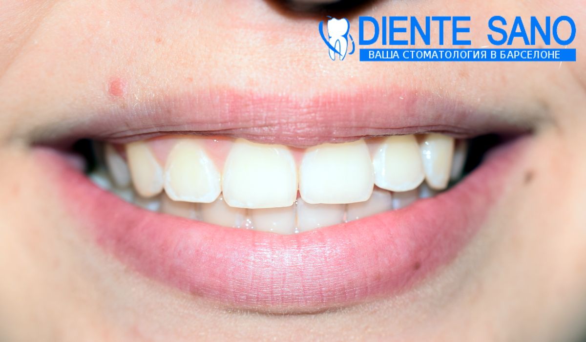 Orthodontics in Barcelona Orthodontics in Barcelona