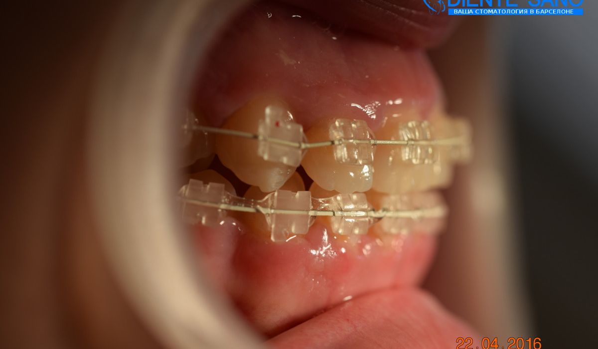 Orthodontics in Barcelona Orthodontics in Barcelona