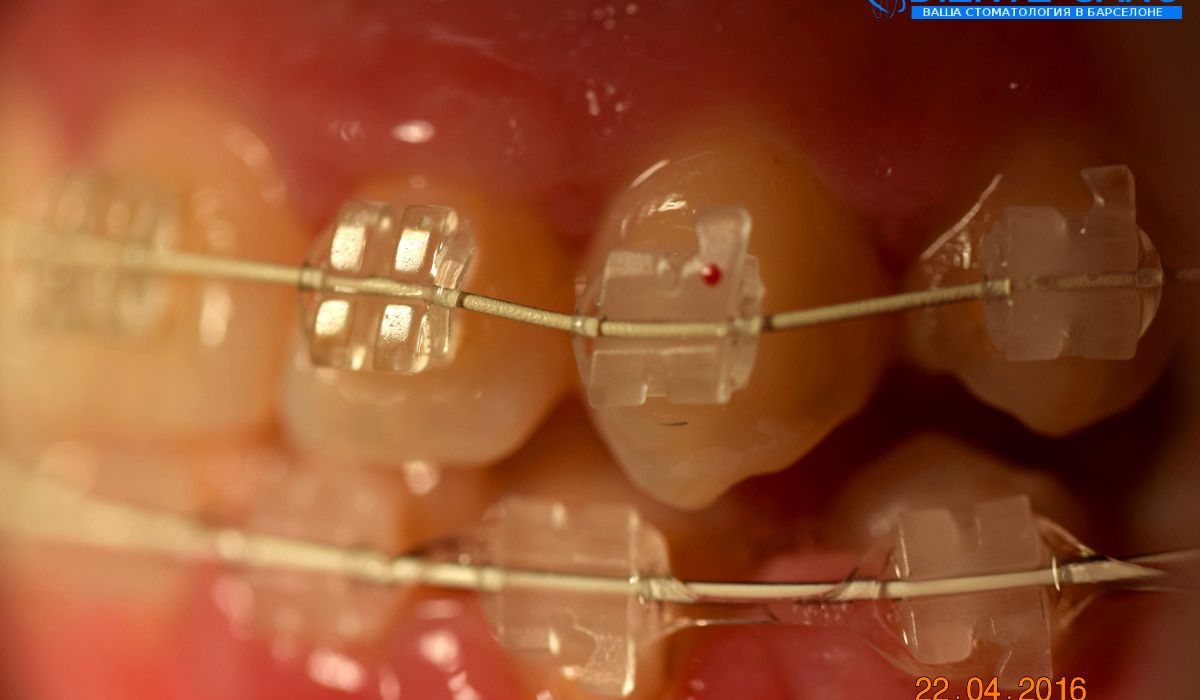 Orthodontics in Barcelona Orthodontics in Barcelona