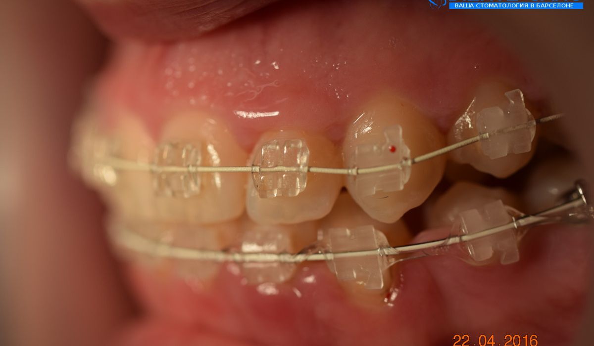 Orthodontics in Barcelona Orthodontics in Barcelona