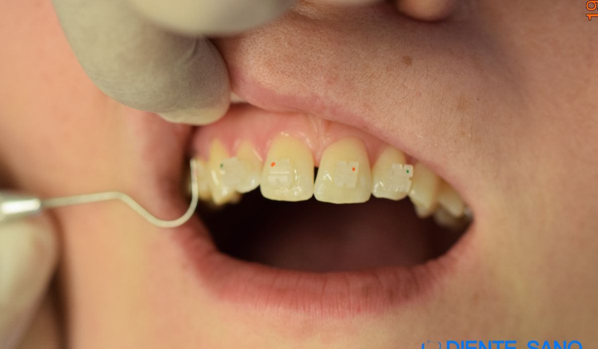 Orthodontics in Barcelona Orthodontics in Barcelona