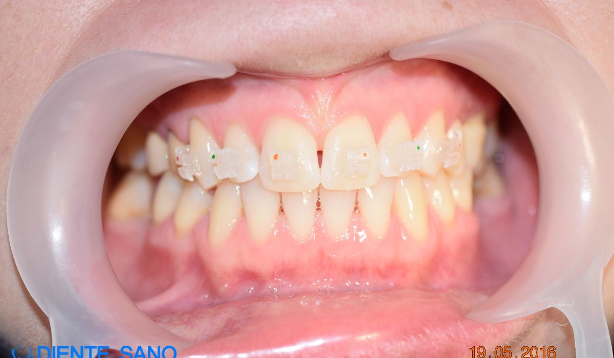 Orthodontics in Barcelona Orthodontics in Barcelona