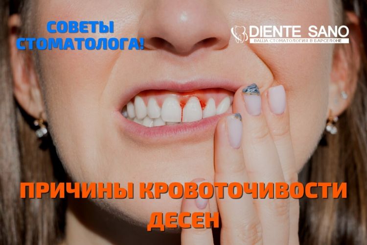 Кровоточивость десен. Причины кровоточивости десен